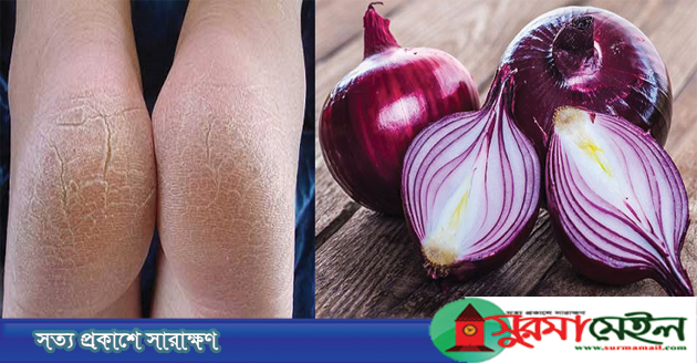 এক রাতেই পা ফাটা দূর করবে পেঁয়াজ!