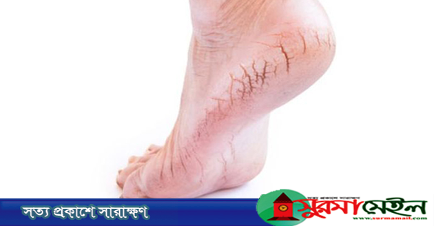 শীতে পায়ের যত্ন নেবেন যেভাবে