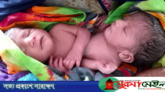 রাজশাহীতে একই পেট নিয়ে ২ শিশুর জন্ম, নেই পায়ুপথ