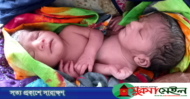 রাজশাহীতে একই পেট নিয়ে ২ শিশুর জন্ম, নেই পায়ুপথ