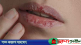 শীতে ফাটছে ঠোঁট? মুক্তি মিলবে ঘরোয়া ৫ উপায়ে