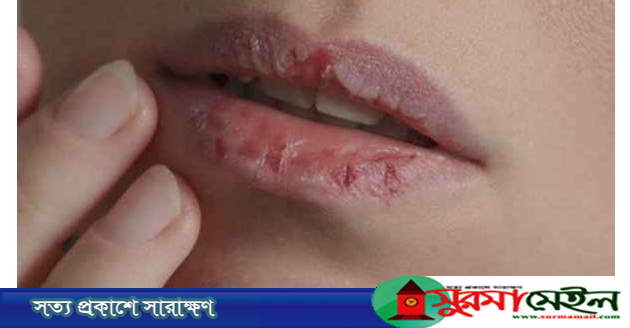 শীতে ফাটছে ঠোঁট? মুক্তি মিলবে ঘরোয়া ৫ উপায়ে