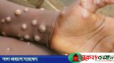 দেশে দেশে ছড়িয়ে পড়ছে মাঙ্কি পক্স