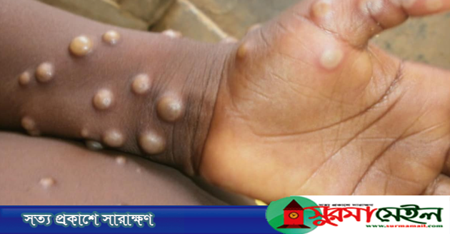 দেশে দেশে ছড়িয়ে পড়ছে মাঙ্কি পক্স