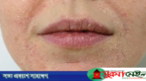 ত্বকের শুষ্কতা দূর করতে