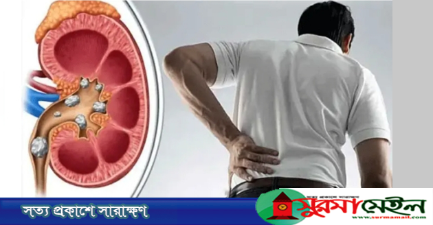 কিডনি রোগ ধরা পড়েছে? মেনে চলুন এই নিয়মগুলো