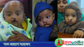 সিলেটে বিনামূল্যে ঠোঁট ও তালুকাটা রোগীদের আধুনিক প্লাস্টিক সার্জারি কার্যক্রমের উদ্বোধন