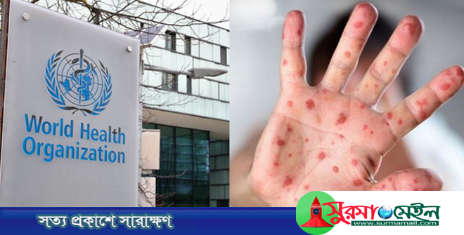 হামের উচ্চ ঝুঁকিতে বাংলাদেশ: ডব্লিউএইচও