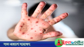 সিলেটে হামের উপসর্গ নিয়ে আরও ২ শিশুর মৃত্যু
