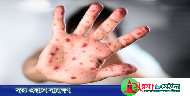 সিলেটে হামের উপসর্গ নিয়ে আরও ২ শিশুর মৃত্যু