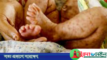 সিলেটে হামের উপসর্গ নিয়ে আরও ৩ শিশুর মৃত্যু