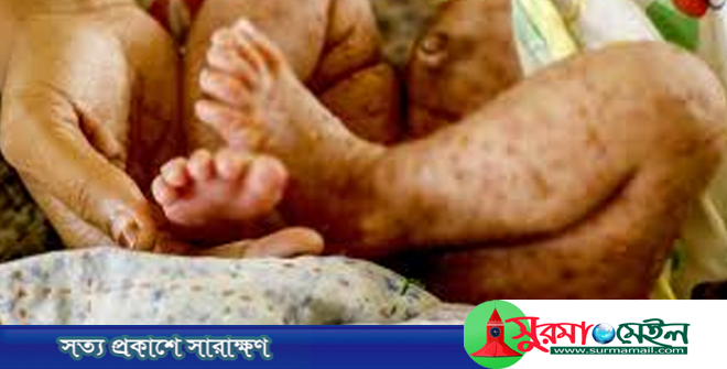 সিলেটে হামের উপসর্গ নিয়ে আরও ৩ শিশুর মৃত্যু