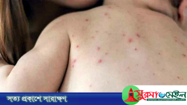 সিলেটে হাম উপসর্গ নিয়ে আরও দুই শিশুর মৃত্যু