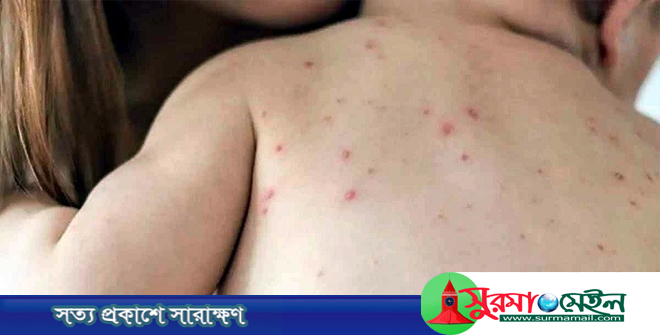 সিলেটে হাম উপসর্গ নিয়ে আরও দুই শিশুর মৃত্যু