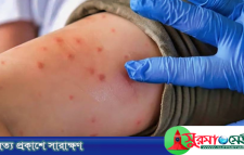 সিলেটে হামের লক্ষণ নিয়ে আরও ৩ শিশুর মৃত্যু