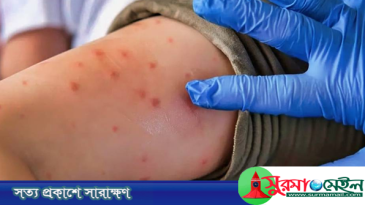 সিলেটে হামের লক্ষণ নিয়ে আরও ৩ শিশুর মৃত্যু