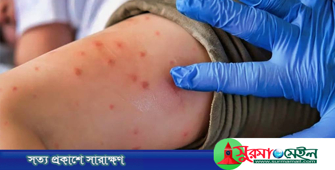 সিলেটে হামের লক্ষণ নিয়ে আরও ৩ শিশুর মৃত্যু