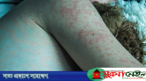 সিলেটে হাম উপসর্গে আরও দুই শিশুর মৃত্যু