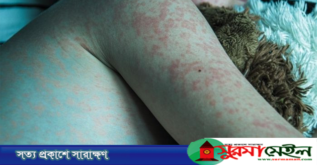 সিলেটে হাম উপসর্গে আরও দুই শিশুর মৃত্যু