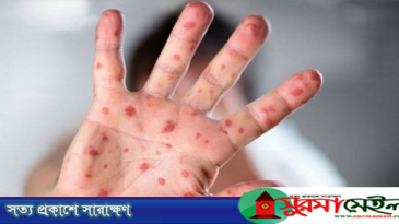 সিলেটে হামের উপসর্গ নিয়ে আরও ২ শিশুর মৃত্যু