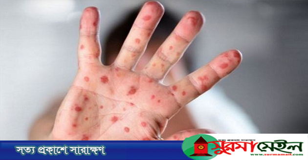 সিলেটে হামের উপসর্গ নিয়ে আরও ২ শিশুর মৃত্যু